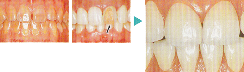 破折・色のくすみ修復の場合：くすみ歯と破折の症例